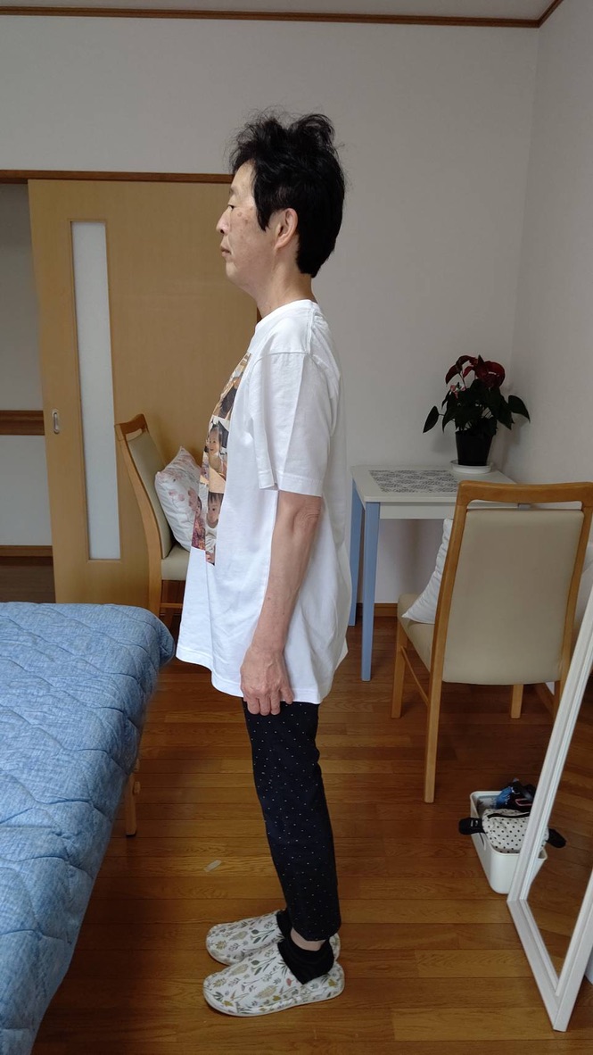 Eさん アフター